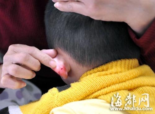 幼儿园三岁童耳朵受伤 称被阿姨用蛋糕夹夹伤