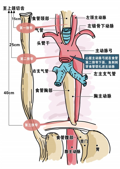 六旬男子硬吞下两根鱼刺　刺穿心脏主动脉险丧命