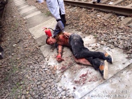 福州一学生爬火车顶玩被高压电击伤 全身80%烧伤