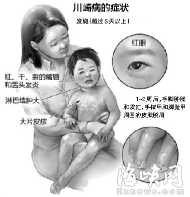 福州一男婴“感冒”险丧命 原是染上川崎病