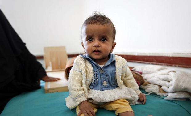 （外代一线）（5）也门：将近220万儿童营养不良