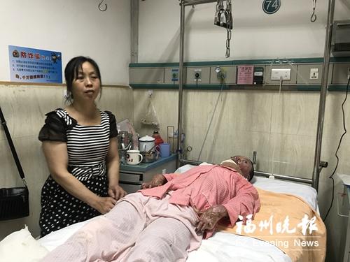 一家五口严重烧伤 大爱榕城温暖了“烧伤妈妈”